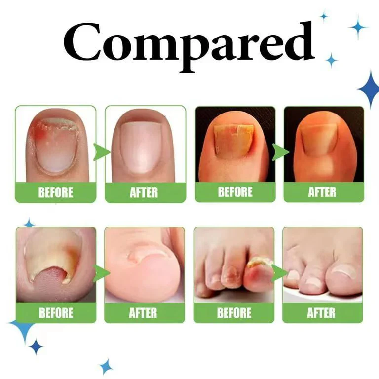 Anti Paronychia Relief Oil (Buy 1 Get 1 FREE)