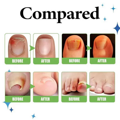 Anti Paronychia Relief Oil (Buy 1 Get 1 FREE)