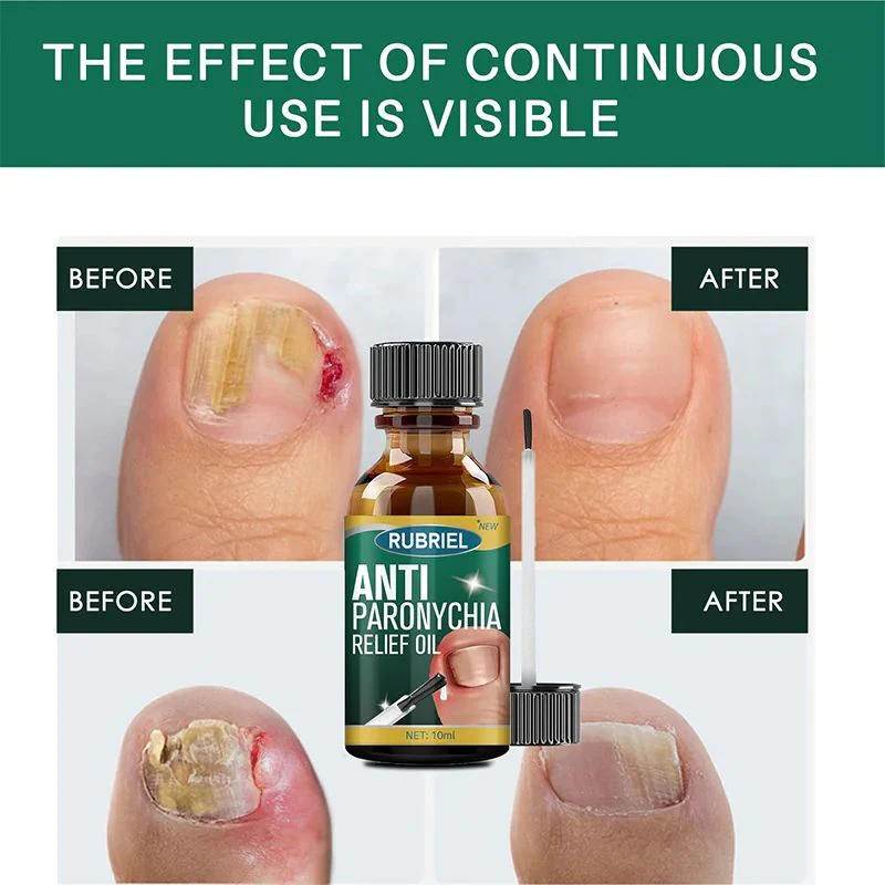 Anti Paronychia Relief Oil (Buy 1 Get 1 FREE)