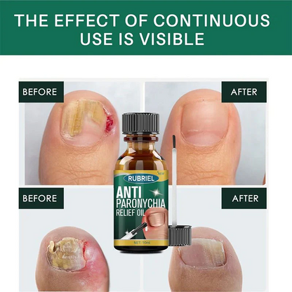 Anti Paronychia Relief Oil (Buy 1 Get 1 FREE)
