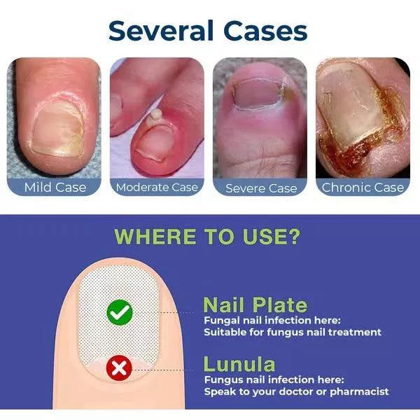 Anti Paronychia Relief Oil (Buy 1 Get 1 FREE)