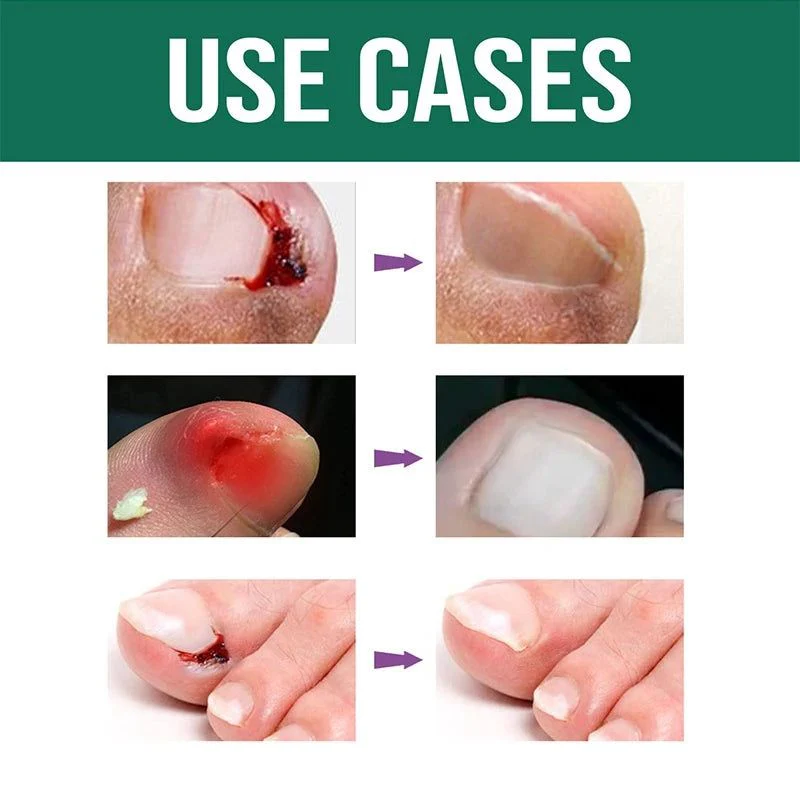 Anti Paronychia Relief Oil (Buy 1 Get 1 FREE)