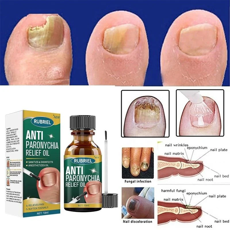 Anti Paronychia Relief Oil (Buy 1 Get 1 FREE)